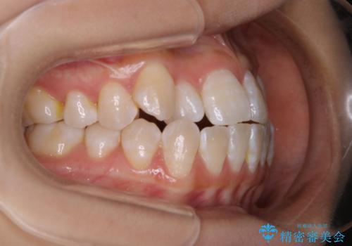前歯のがたつきとオープンバイト:インビザラインでまとめて治すの治療前
