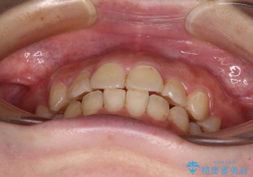 見えないほど重なっている前歯　抜歯矯正でスッキリとした歯並びにの治療後