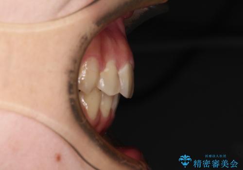 見えないほど重なっている前歯 抜歯矯正でスッキリとした歯並びにの治療後