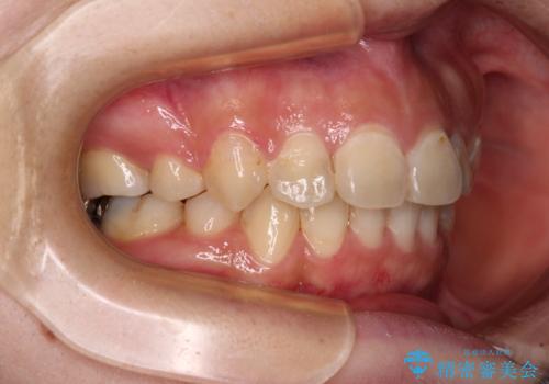 見えないほど重なっている前歯 抜歯矯正でスッキリとした歯並びにの治療後