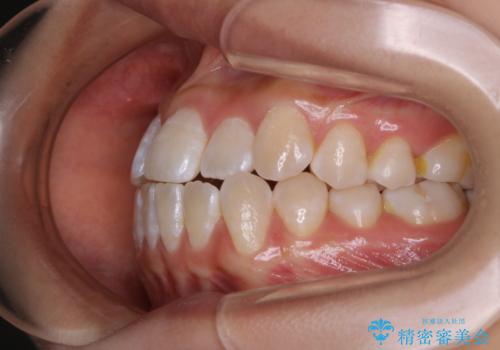 前歯のがたつきとオープンバイト:インビザラインでまとめて治すの治療前