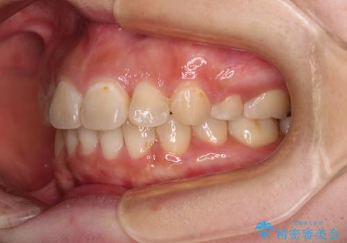 見えないほど重なっている前歯 抜歯矯正でスッキリとした歯並びにの治療後