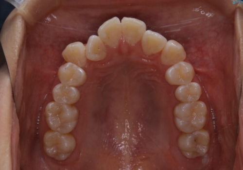 前歯のがたつきとオープンバイト:インビザラインでまとめて治すの治療前