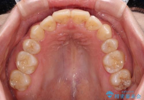 見えないほど重なっている前歯 抜歯矯正でスッキリとした歯並びにの治療後
