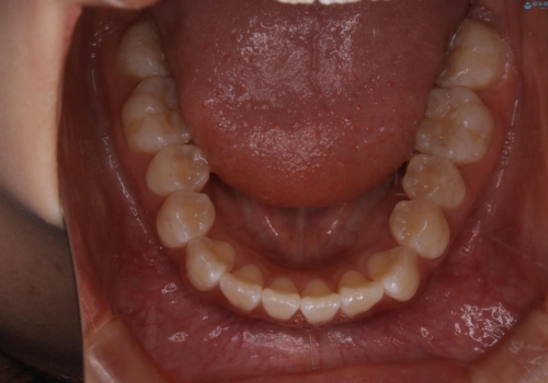 前歯のがたつきとオープンバイト:インビザラインでまとめて治すの治療前