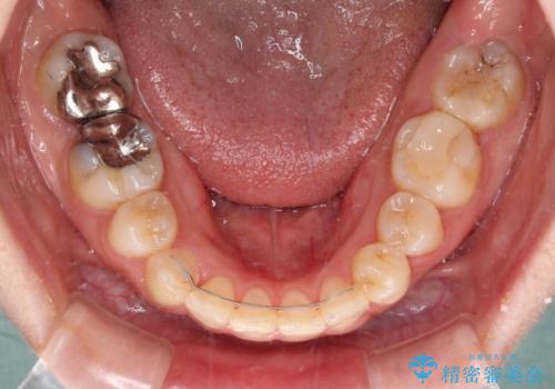 見えないほど重なっている前歯 抜歯矯正でスッキリとした歯並びにの治療後