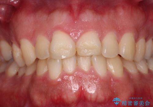 ロードバイク運転中に転倒 欠けてしまった前歯のオールセラミック治療の治療前