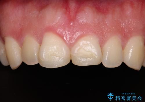 ロードバイク運転中に転倒 欠けてしまった前歯のオールセラミック治療の治療前