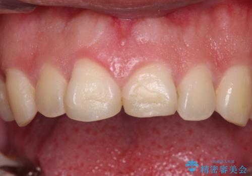 ロードバイク運転中に転倒 欠けてしまった前歯のオールセラミック治療の治療前