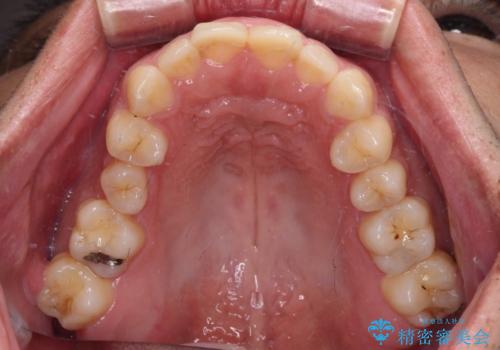 ロードバイク運転中に転倒 欠けてしまった前歯のオールセラミック治療の治療前