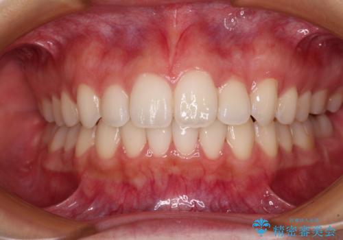 【モニター】前歯のクロスバイトをインビザラインで治療の症例 治療後