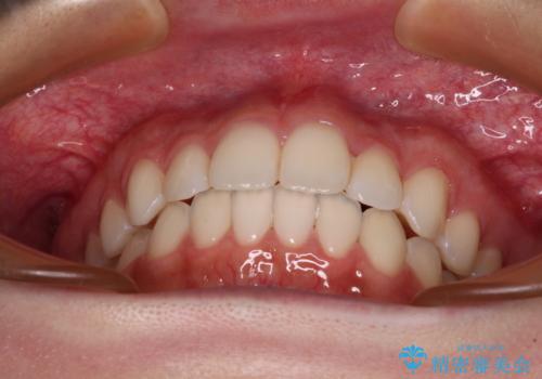 【モニター】前歯のクロスバイトをインビザラインで治療の治療後