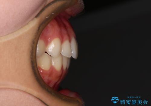 【モニター】前歯のクロスバイトをインビザラインで治療の治療後