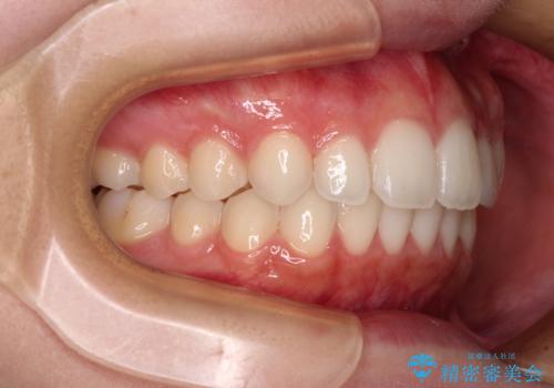 【モニター】前歯のクロスバイトをインビザラインで治療の治療後