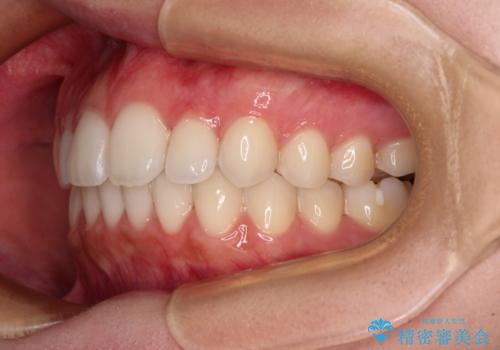 【モニター】前歯のクロスバイトをインビザラインで治療の治療後