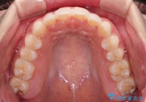 【モニター】前歯のクロスバイトをインビザラインで治療の治療後