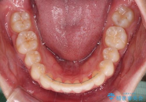 【モニター】前歯のクロスバイトをインビザラインで治療の治療後