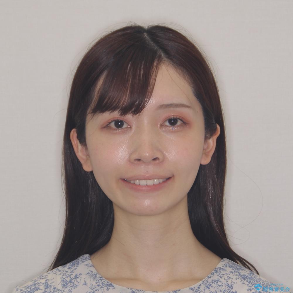 【モニター】前歯のクロスバイトをインビザラインで治療の治療後(顔貌)