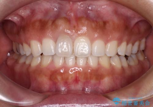 隙間の空いた前歯を閉じたい インビザライン矯正の症例 治療後