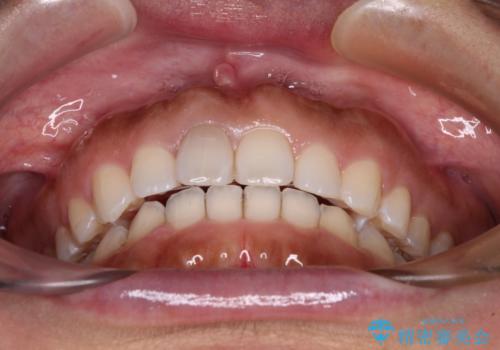 隙間の空いた前歯を閉じたい インビザライン矯正の治療後