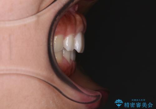 隙間の空いた前歯を閉じたい インビザライン矯正の治療後