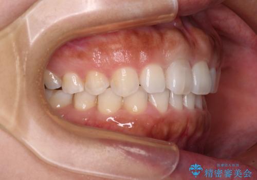 隙間の空いた前歯を閉じたい インビザライン矯正の治療後