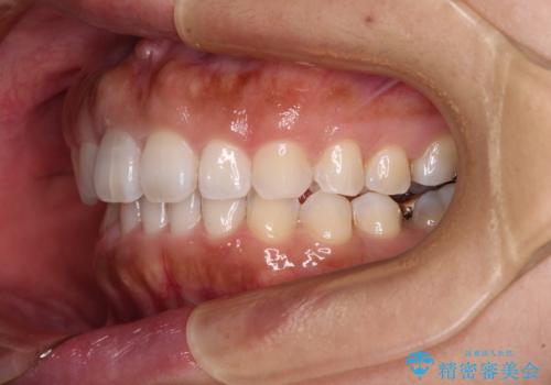 隙間の空いた前歯を閉じたい インビザライン矯正の治療後