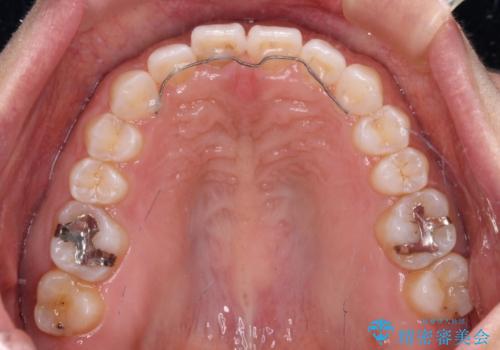 隙間の空いた前歯を閉じたい インビザライン矯正の治療後