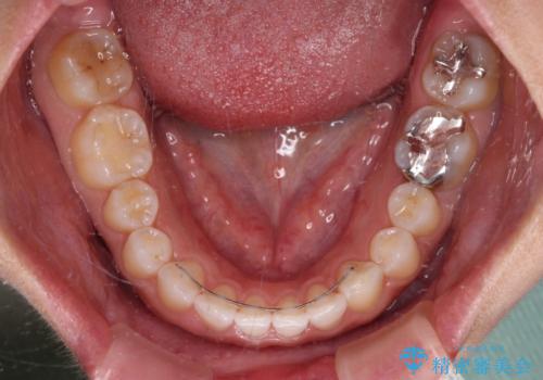 隙間の空いた前歯を閉じたい インビザライン矯正の治療後