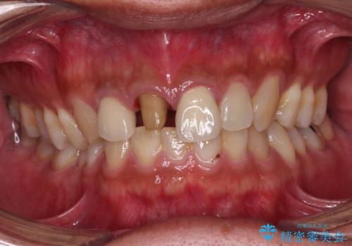 変色した前歯を治したい オールセラミッククラウンによる補綴の治療中