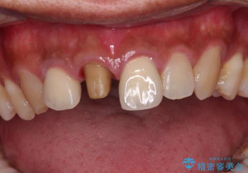 変色した前歯を治したい オールセラミッククラウンによる補綴の治療中