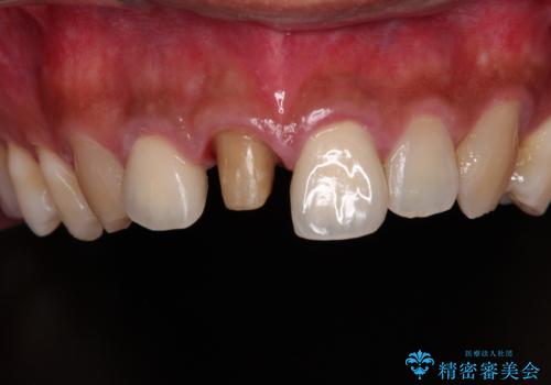 変色した前歯を治したい オールセラミッククラウンによる補綴の治療中