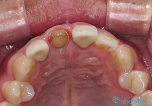 変色した前歯を治したい オールセラミッククラウンによる補綴の治療中