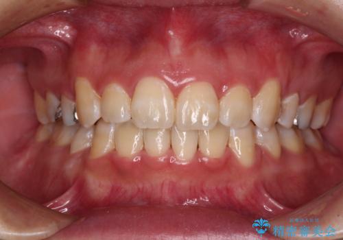 閉じにくい口元と八重歯 ワイヤー装置での抜歯矯正の症例 治療後