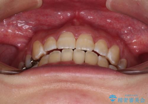 閉じにくい口元と八重歯 ワイヤー装置での抜歯矯正の治療後