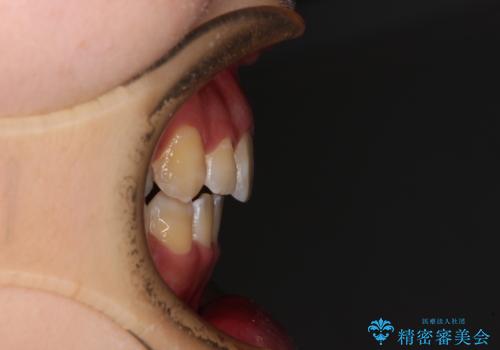 閉じにくい口元と八重歯 ワイヤー装置での抜歯矯正の治療後