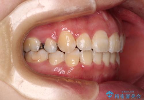閉じにくい口元と八重歯　ワイヤー装置での抜歯矯正の治療後