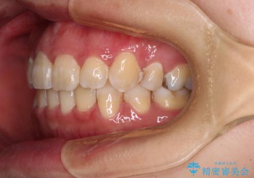 閉じにくい口元と八重歯 ワイヤー装置での抜歯矯正の治療後