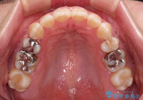 閉じにくい口元と八重歯　ワイヤー装置での抜歯矯正の治療後