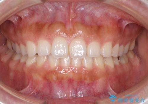隙間の空いた前歯を閉じたい インビザライン矯正の治療中