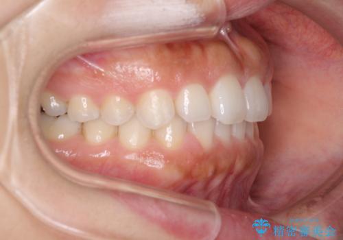 隙間の空いた前歯を閉じたい インビザライン矯正の治療中