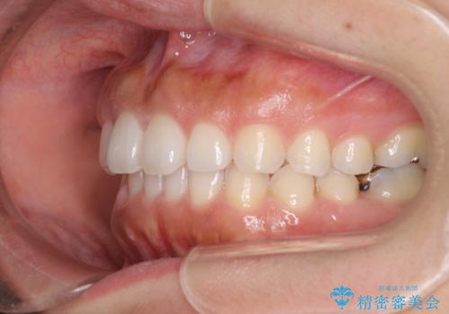 隙間の空いた前歯を閉じたい インビザライン矯正の治療中