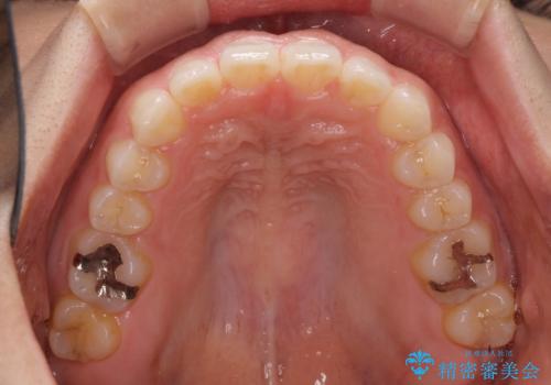 隙間の空いた前歯を閉じたい インビザライン矯正の治療中