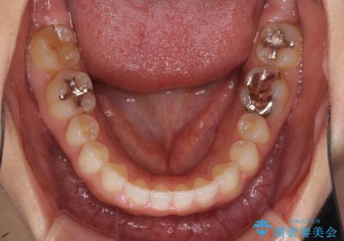 隙間の空いた前歯を閉じたい　インビザライン矯正の治療中