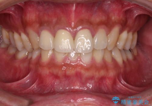 変色した前歯を治したい オールセラミッククラウンによる補綴の治療後