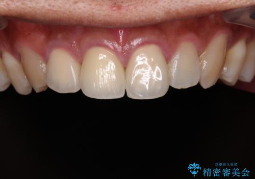 変色した前歯を治したい オールセラミッククラウンによる補綴の治療後