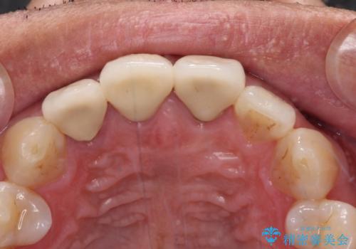 変色した前歯を治したい オールセラミッククラウンによる補綴の治療後