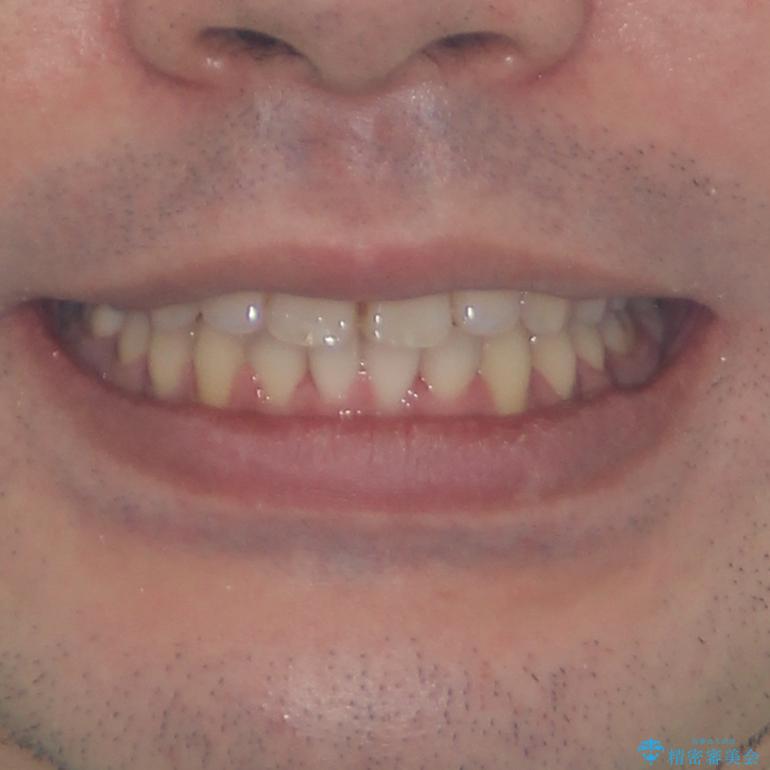 早くて安くて楽ちん メタルブラケットでの矯正治療の治療後(顔貌)