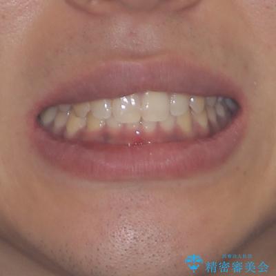 デコボコとディープバイトを治したい インビザラインによる矯正治療の治療後(顔貌)