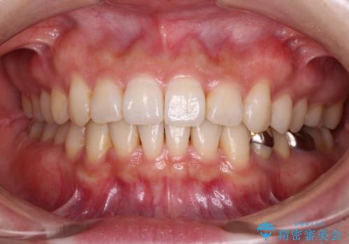 ディープバイトとデコボコを解消 インビザライン矯正の症例 治療後